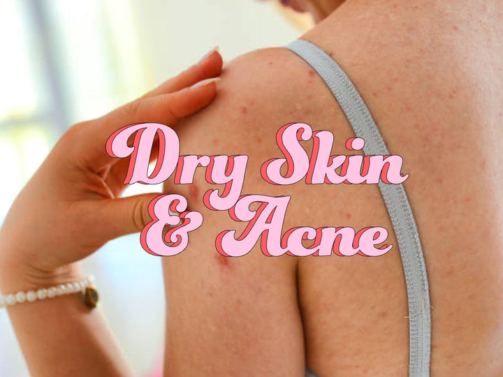 How dry skin causes acne