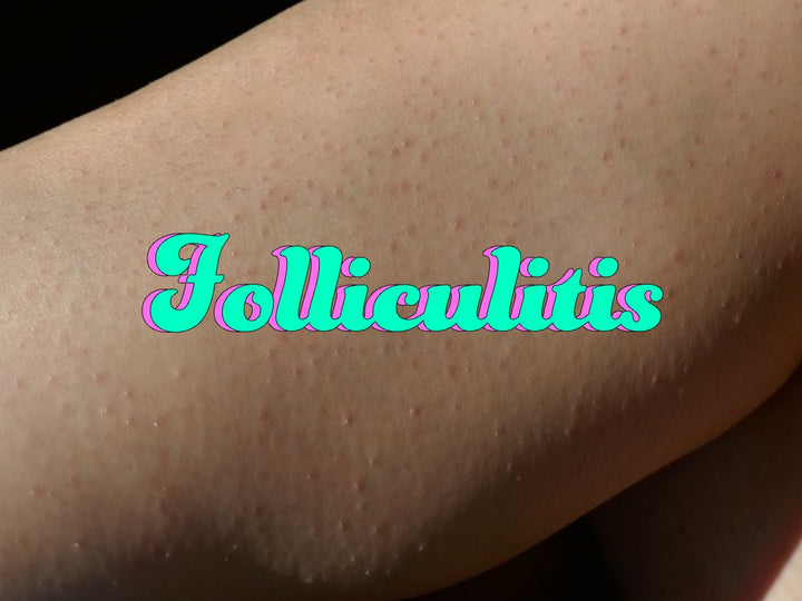 exfoliating body scrub for folliculitis