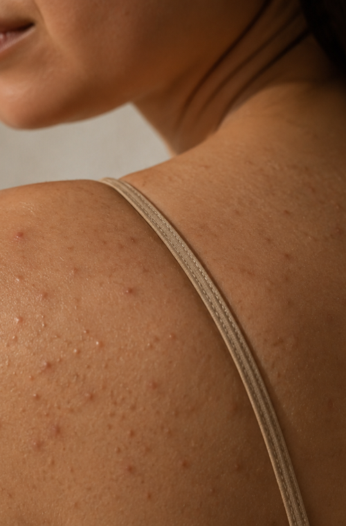 Body Acne