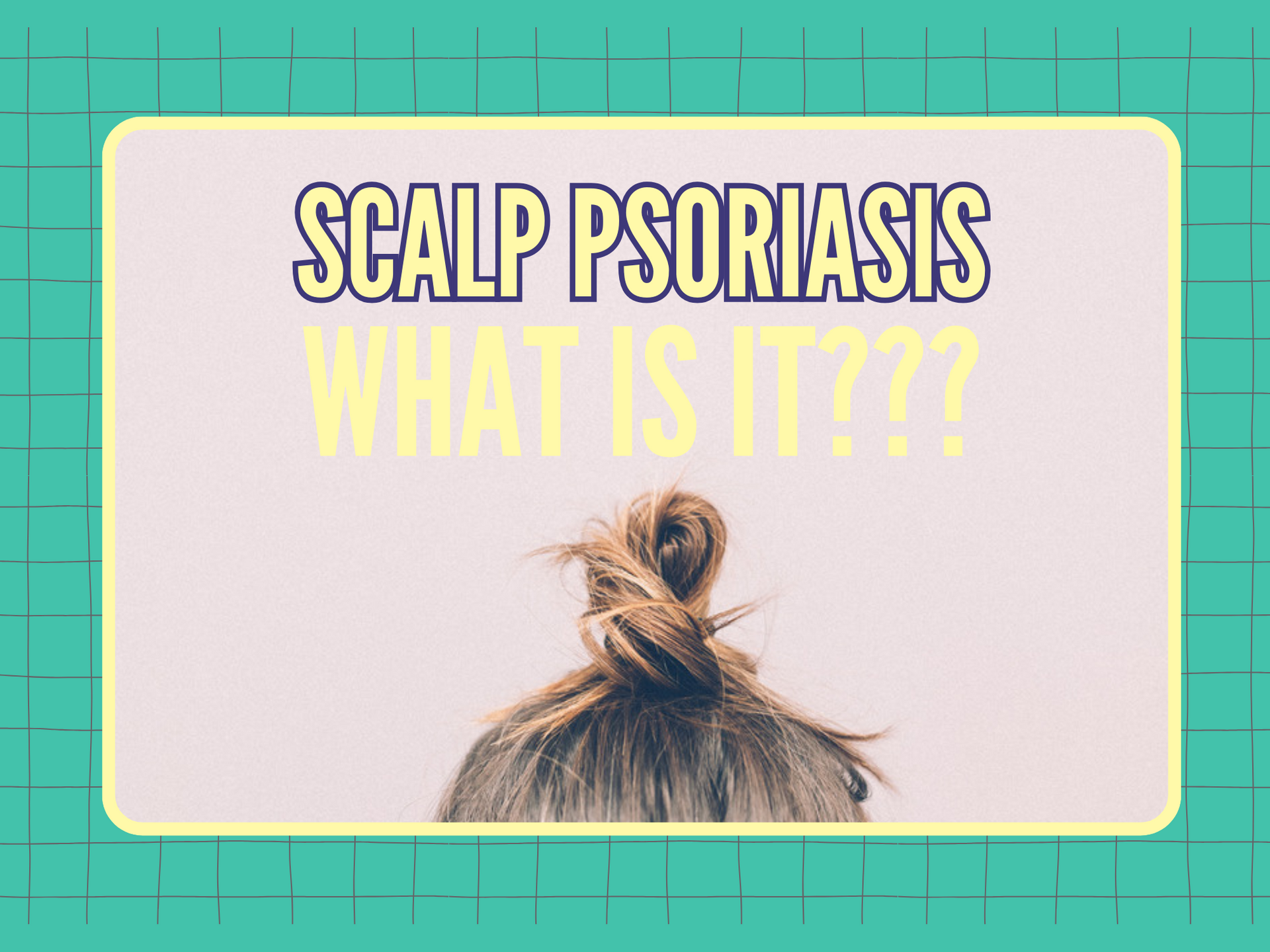 What is scalp psoriasis & how to treat it