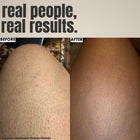 Ingrown Hair Treatment