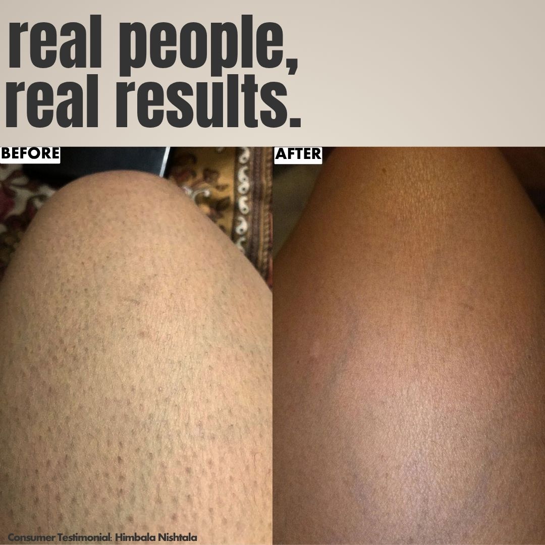 Ingrown Hair Treatment