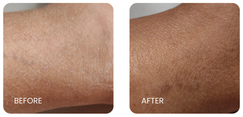 Dry Skin