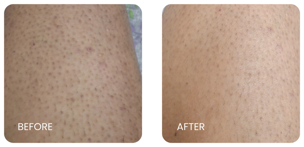 Ingrown Hair result