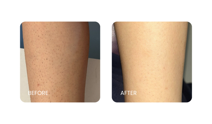 Before and After