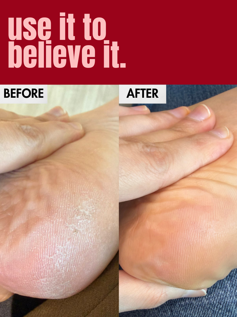 Before & After using Foot balm on your dry heels